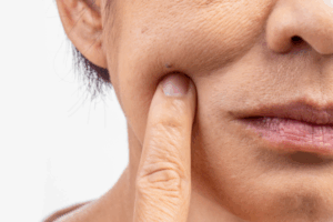 What is Ozempic face? What you need to know about it