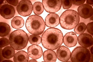 Do Fat Cells Enlarge and Burst with Rapid Weight Gain?