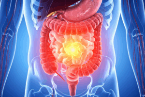 Leaky Gut